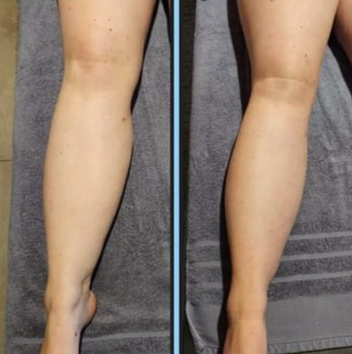 Lumeyr Lymphatic Drainer