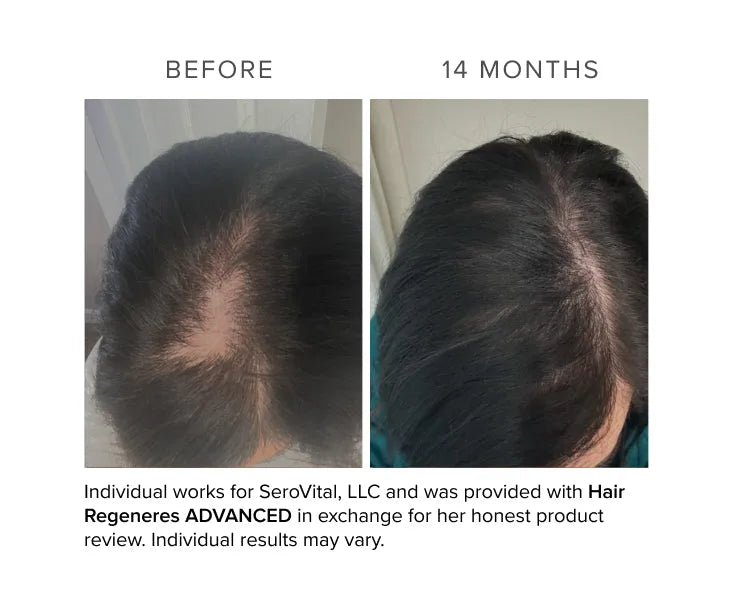 Before and after comparison of hair regrowth treatment on a person's head, showing visible difference in hair density.