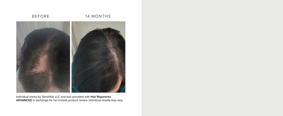 Before and after comparison of hair regrowth treatment on a person's head.